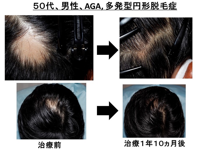 円形脱毛症　病院